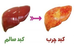 کبد چرب