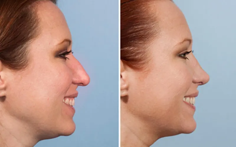 Treatment of drooping nose tip