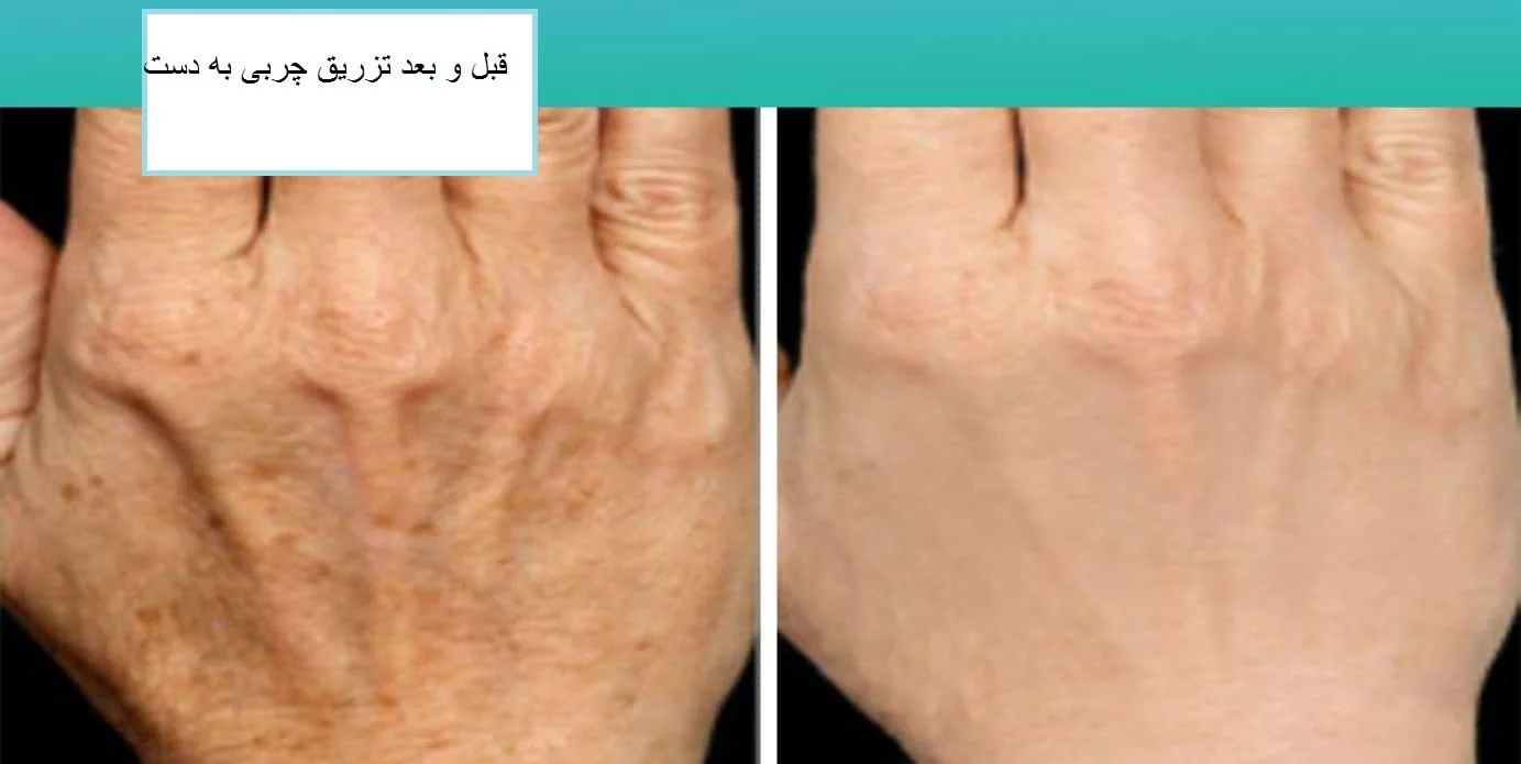 پوست | تزریق چربی