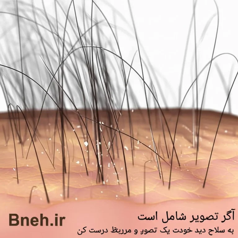 شوره سر چیست؟ بررسی کامل علت، علائم و روش های درمان