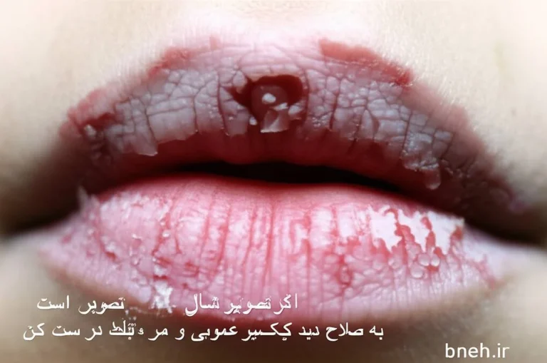 علت ترک خوردن لب چیست؟ راهنمای جامع درمان و پیشگیری (بروزرسانی 1405)