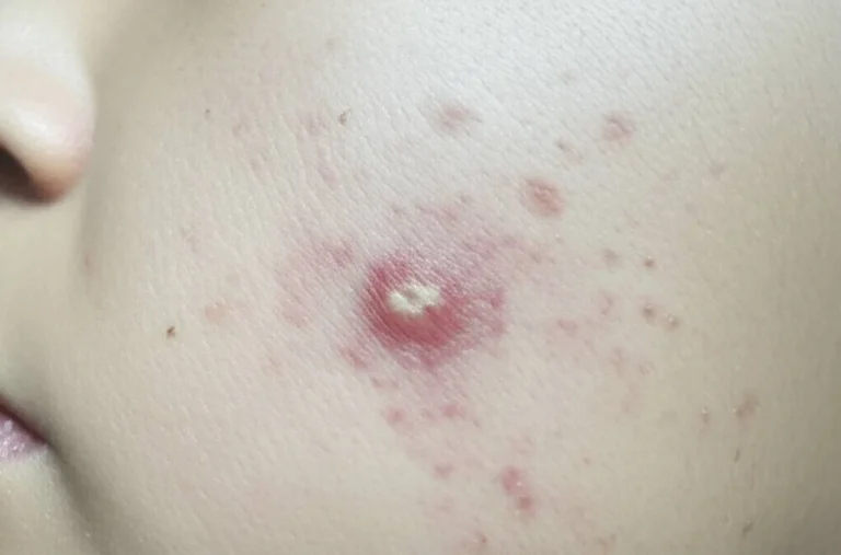 علت جوش زدن پوست صورت خشک چیست و بهترین روش درمان آن کدام است؟
