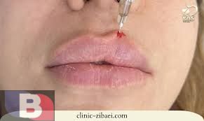 چند روز بعد از فیلر لب میشه رژ زد