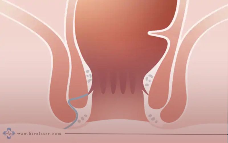 فیستول مقعدی