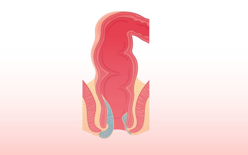 بواسیر مقعدی