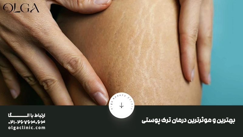 بهترین روشهای درمان ترک پوستی